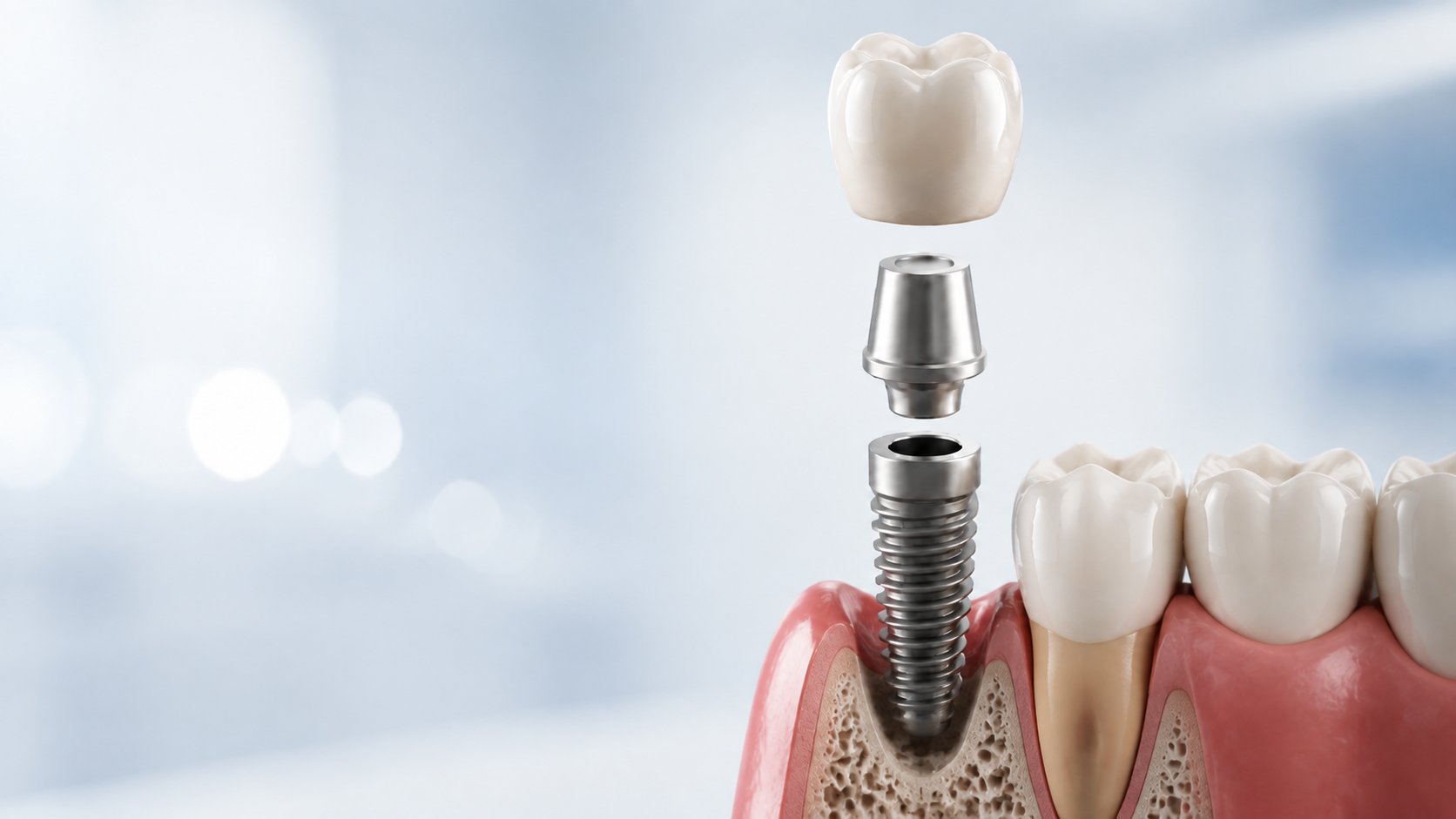 Diş implantı uygulaması